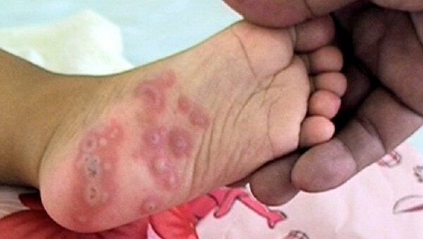 Bệnh tay chân miệng vào mùa: Những điều cần biết