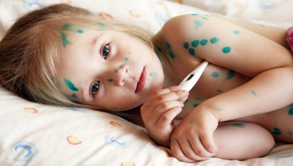 Dấu hiệu và cách chăm sóc bệnh nhân bị thủy đậu