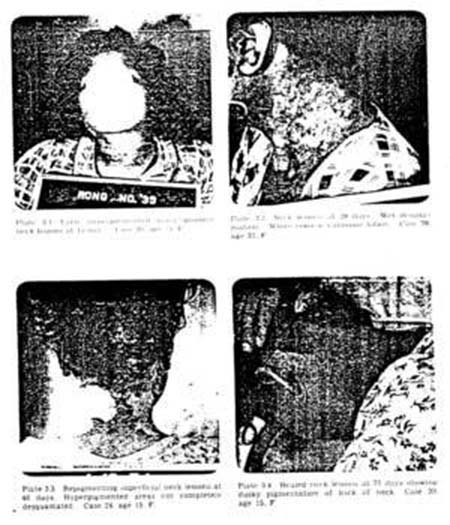 Hình ảnh khối u của một nạn nhân phóng xạ. Những thí nghiệm kỳ quặc nhất mọi thời đại